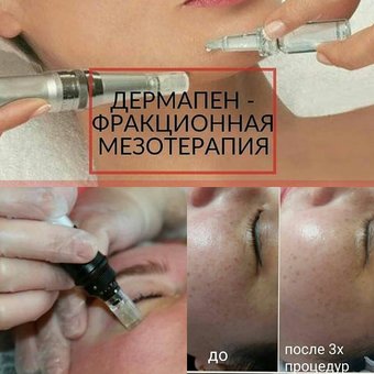 Microneedling (dermapen) is an excellent alternative to injection biorevitalization and mesotherapy