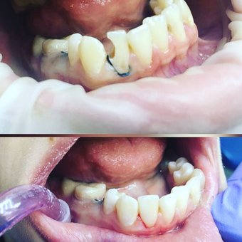 Tooth restoration