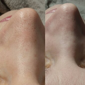 Facial cleansing and peeling - all in one procedure