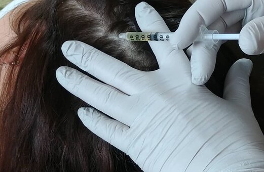 Mesotherapy for hair in winter - it's time