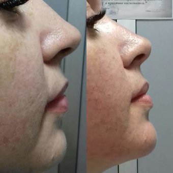 Facial massage - result in 10 procedures