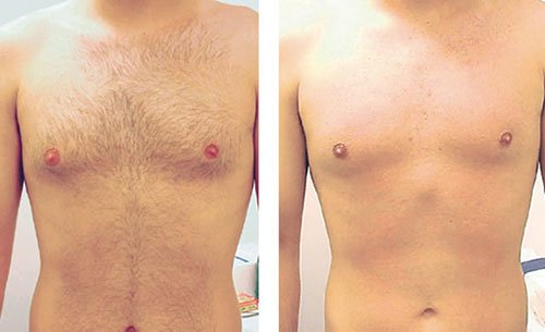 Laser hair removal for men - a chance to forget about irritation and daily shaving!